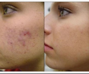 Комплексный подход к лечению угревой сыпи